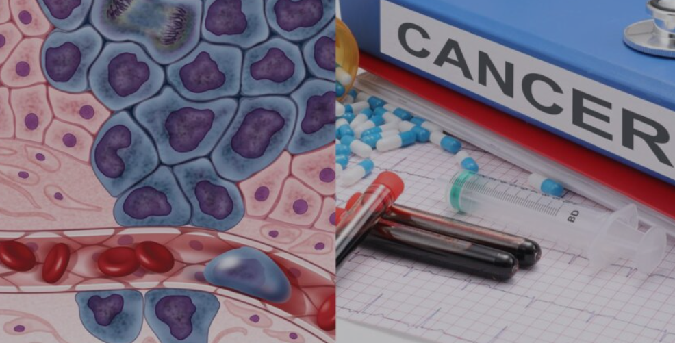 Hodgkin Lymphoma Symptoms: Teen’s Story Warns All Hodgkin Lymphoma Symptoms