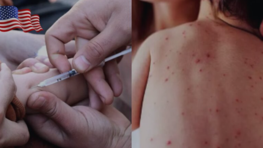 Texas Measles Outbreak