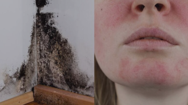 UK Mould Allergic Reaction